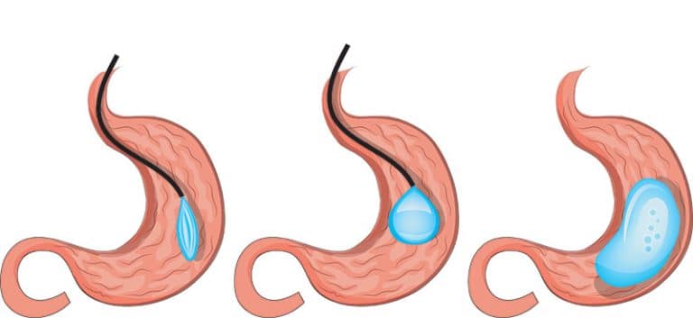 Intragastric balloon in Malaysia