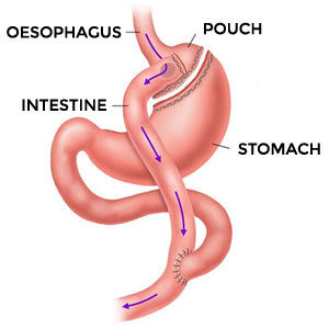 Bariatric-Surgery-05 Bariatric-Surgery-05