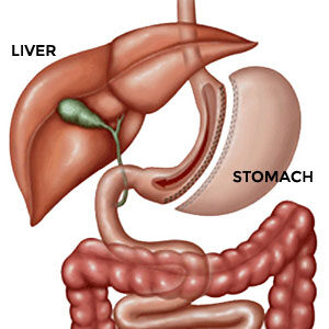 Bariatric-Surgery-07 Bariatric-Surgery-07